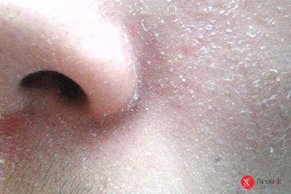 7 dấu hiệu nhận biết sữa rửa mặt không hợp da - thay đổi ngay kẻo muộn 2 Da khô, căng rát sau khi rửa mặt