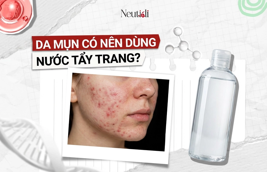 Giải đáp: Bị mụn có nên dùng nước tẩy trang? 1 Da mụn có nên dùng nước tẩy trang?