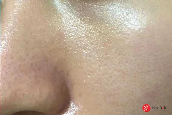 7 dấu hiệu nhận biết sữa rửa mặt không hợp da - thay đổi ngay kẻo muộn 4 Sau khi rửa mặt da tiết nhiều dầu hơn