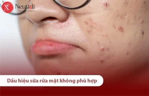 Dấu hiệu sữa rửa mặt không hợp với da của bạn