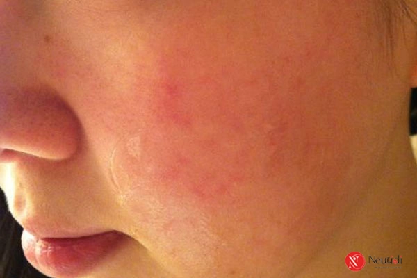 Sữa rửa mặt hết hạn có dùng được không? 5 tác hại nghiêm trọng cần biết 4 Dị ứng da do sữa rửa hạn hết hạn