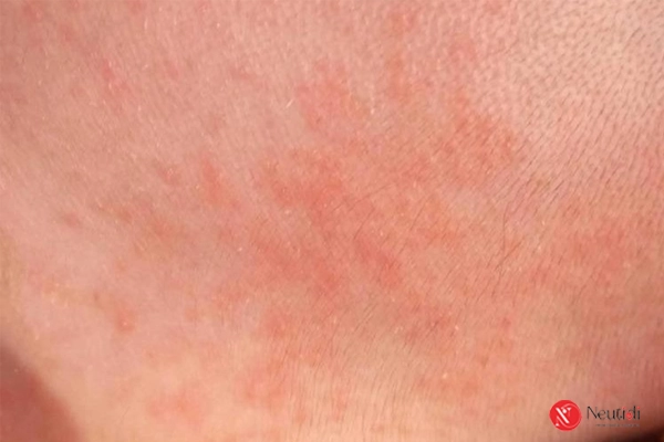 Sữa rửa mặt hết hạn có dùng được không? 5 tác hại nghiêm trọng cần biết 3 Kích ứng và đỏ rát da do dùng sữa rửa mặt hết hạn