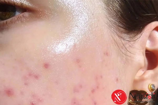 Hàng rào bảo vệ da suy yếu