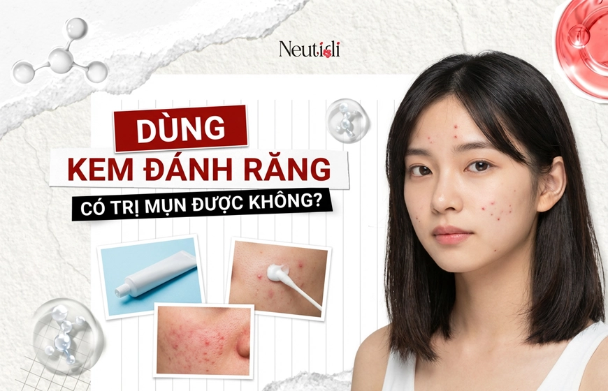 Dùng kem đánh răng có trị mụn được không hay chỉ gây hại da thêm? 1 Kem đánh răng có trị mụn được không?
