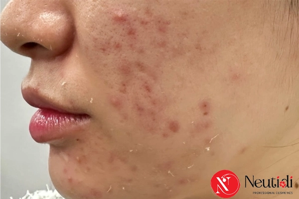 Mụn tái phát do nội tiết