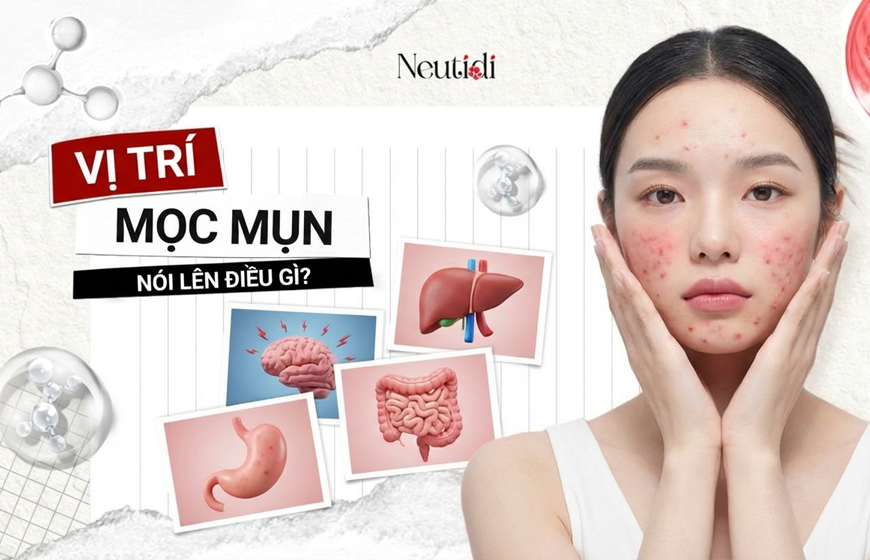 Giải mã 12 vị trí mọc mụn trên mặt: Cảnh báo sức khoẻ gan - phổi - tiêu hoá 1 Vị trí mọc mụn trên mặt nói lên điều gì?
