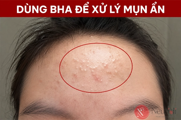 Trị mụn ẩn cho da dầu : Hiểu đúng nguyên nhân và cách xử lý 3 Sử dụng hoạt chất BHA để hỗ trợ giảm mụn ẩn