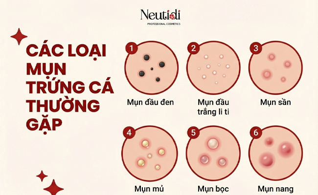 Các loại mụn trứng cá thường gặp
