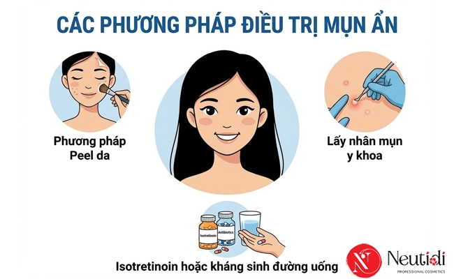 Mụn ẩn có tự hết không? Bao lâu thì khỏi? 5 Phương pháp trị mụn ẩn chuyên sâu
