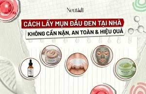 5 Cách lấy mụn đầu đen tại nhà không cần nặn, an toàn, hiệu quả 21 Cách lấy mụn đầu đen tại nhà không cần nặn