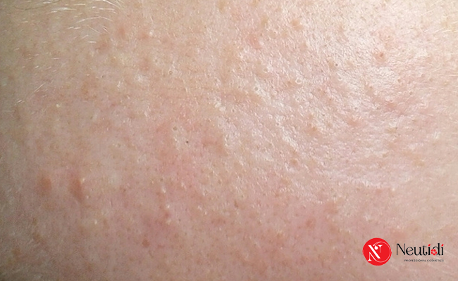 Đẩy mụn ẩn là gì