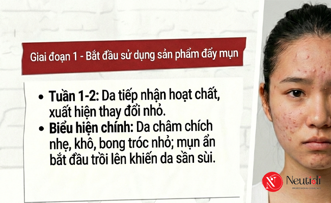 Giai đoạn 1 của quá trình đẩy mụn ẩn