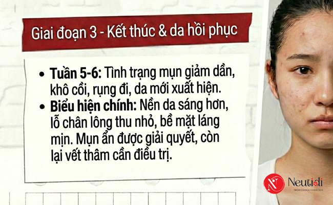 Giai đoạn 3: Đẩy mụn ẩn