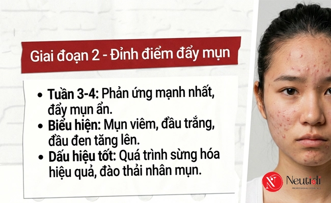 Giai đoạn 2 trong quá trình đẩy mụn ẩn