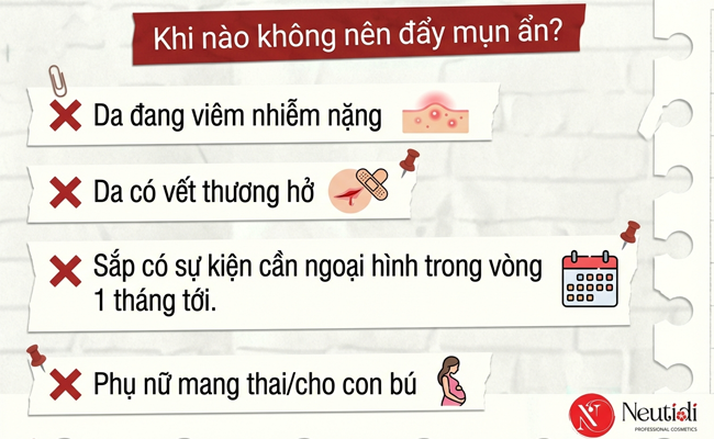Khi nào không nên đẩy mụn ẩn?