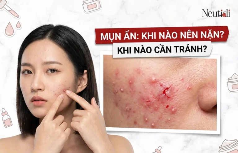 Mụn ẩn có nên nặn