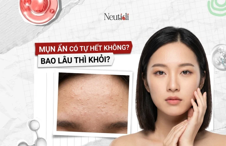 Giải đáp thắc mắc: Mụn ẩn có tự hết không?