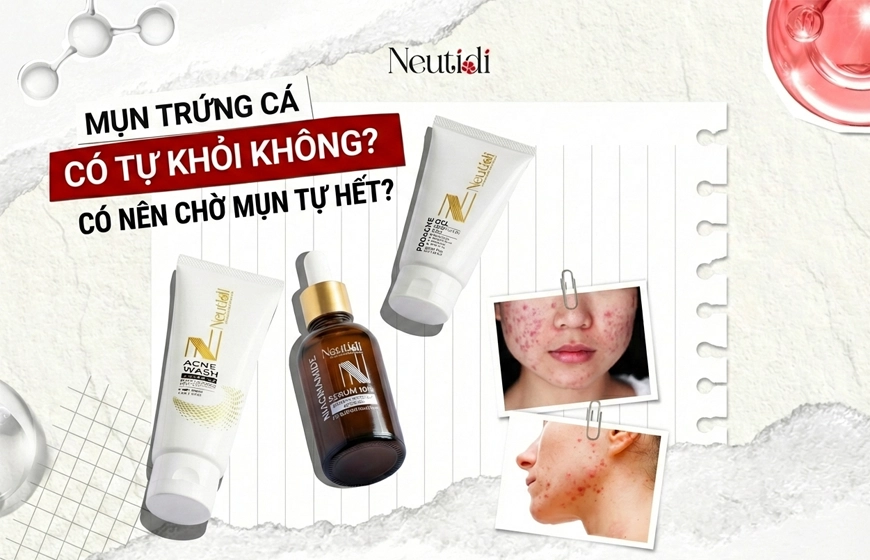 Mụn trứng cá có tự hết không?