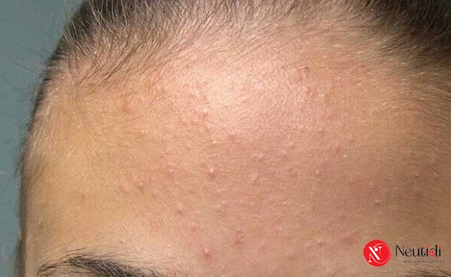 những nguyên nhân khiến da dầu bị mụn ẩn