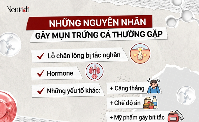 Những nguyên nhân gây mụn trứng cá