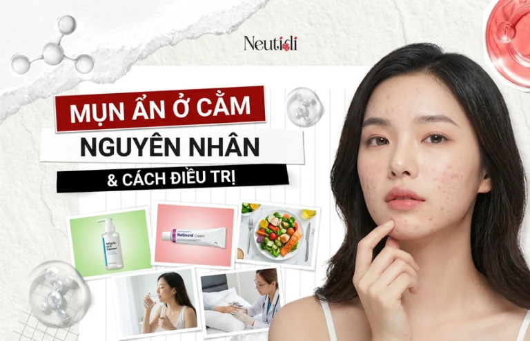 nguyen nhan mun an o cam