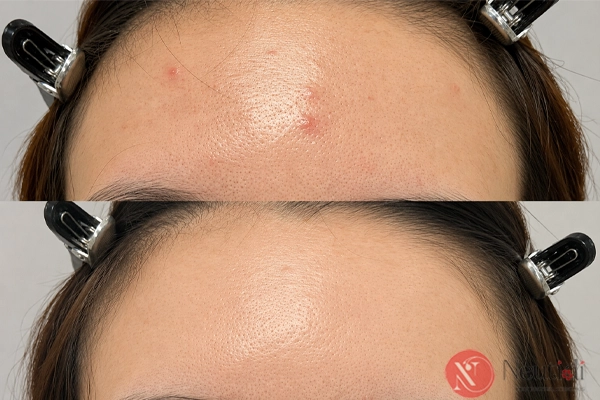 Nhận biết loại mụn viêm trước khi xử lý