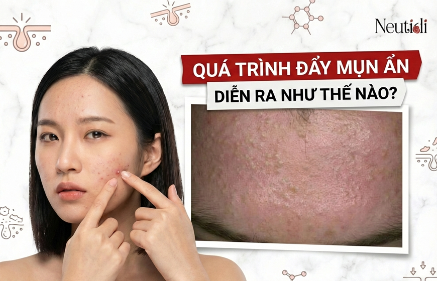 Quá trình đẩy mụn ẩn diễn ra như thế nào?