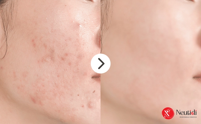 Chữa mụn ẩn cho da dầu bằng liệu pháp chuyên sâu