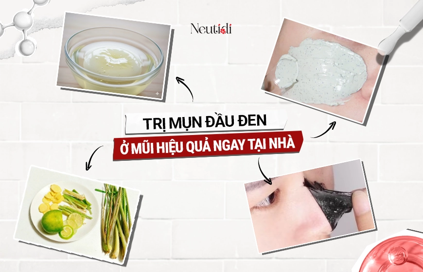 9 Cách trị mụn đầu đen ở mũi tận gốc - hiệu quả ngay tại nhà 1 Những cách trị mụn đầu đen ở mũi