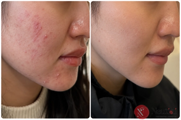 Trị mụn viêm bao lâu thì mới thấy hiệu quả?