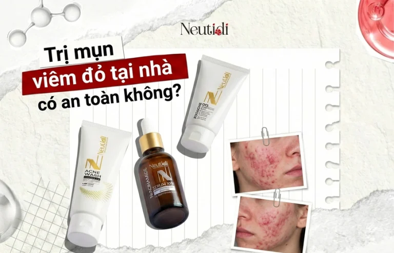 Trị mụn viêm đỏ tại nhà hiệu quả