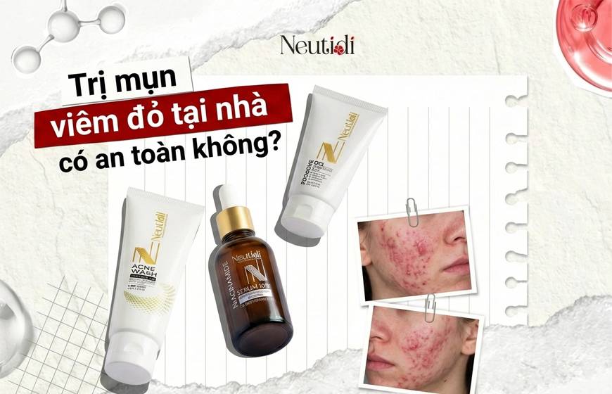 Trị mụn viêm đỏ tại nhà hiệu quả