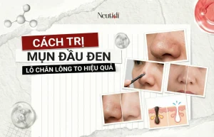 8 cách trị mụn đầu đen lỗ chân lông to hiệu quả thật ngay tại nhà 26 Cách trị mụn đầu đen lỗ chân lông to