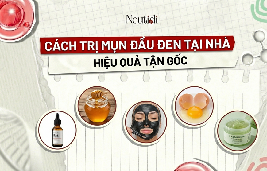 Cách trị mụn đầu đen tại nhà