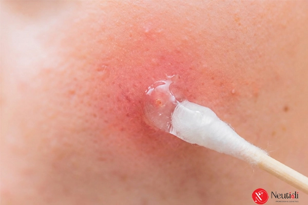 Xử lý khi mụn đầu đen chuyển sang viêm sưng đỏ 5 Chấm mụn đầu đen bị viêm