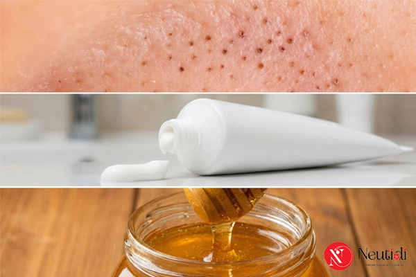 Trị mụn đầu đen ở mũi bằng kem đánh răng có hiệu quả? Thực hiện ra sao? 4 Kem đánh răng kết hợp mật ong trị mụn đầu đen ở mũi