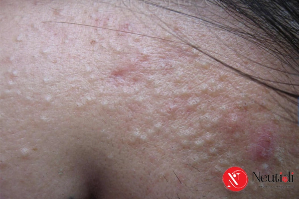 Phân biệt mụn ẩn với mụn đầu đen 2 Tìm hiểu về mụn ẩn