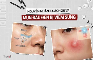 Xử lý khi mụn đầu đen chuyển sang viêm sưng đỏ 1 Mụn đầu đen bị viêm sưng