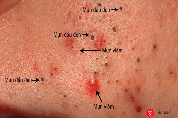Xử lý khi mụn đầu đen chuyển sang viêm sưng đỏ 2 Nguyên nhân Mụn đầu đen bị viêm sưng
