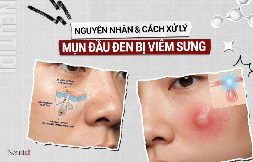 Xử lý khi mụn đầu đen chuyển sang viêm sưng đỏ 1 Mụn đầu đen bị viêm sưng