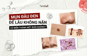 Mụn đầu đen để lâu không nặn có thành nốt ruồi không? 31 Mụn đầu đen có thành nốt rồi không?