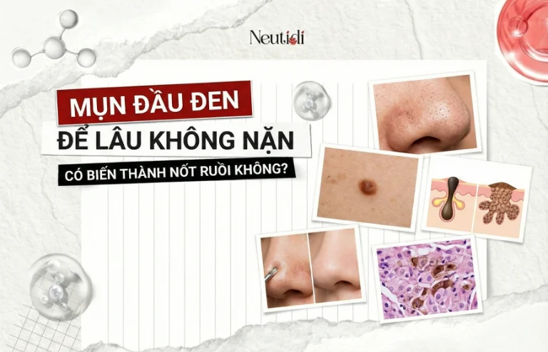 Mụn đầu đen có thành nốt rồi không?