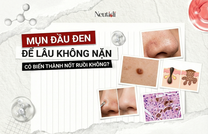 Mụn đầu đen có thành nốt rồi không?