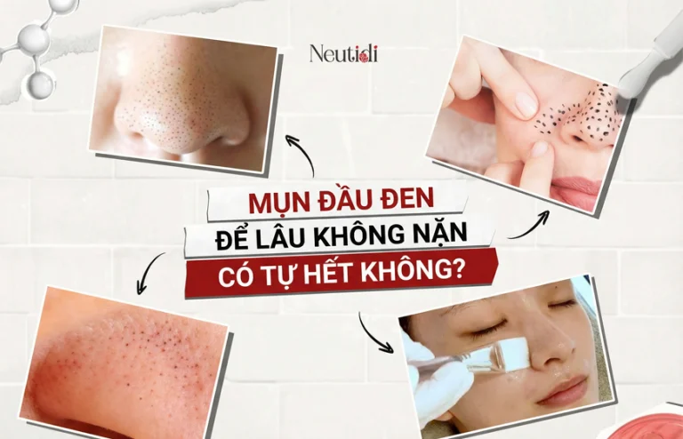Mụn đầu đen để lâu có tự hết không?