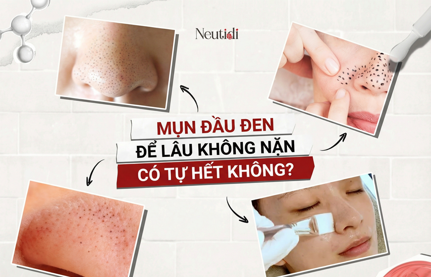 Mụn đầu đen để lâu có tự hết không?