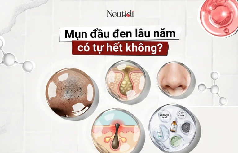 Mụn đầu đen lâu năm có tự hết không?
