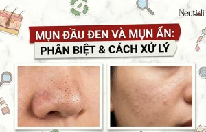 Mụn ẩn & mụn đầu đen: Phân biệt & điều trị đúng cách 10 Mụn đầu đen mụn ẩn