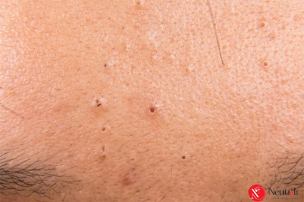 7 nguyên nhân mụn đầu đen ở trán + cách trị dứt điểm hiệu quả 2 Mụn đầu đen vùng trán
