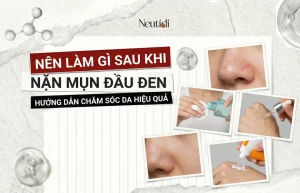 Sau khi nặn mụn đầu đen nên làm gì để không bị thâm sẹo, to lỗ chân lông? 6 Nên làm gì sau khi nặn mụn đầu đen
