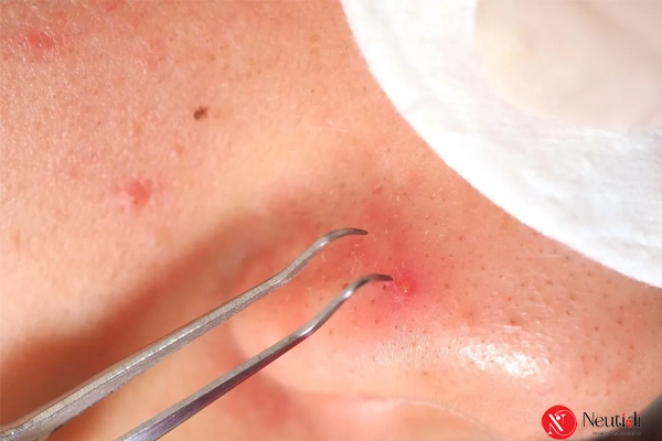 Xử lý khi mụn đầu đen chuyển sang viêm sưng đỏ 8 Nặn mụn khi đang viêm